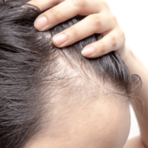 Hair Thinning