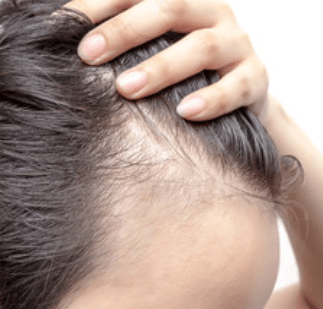 Hair Thinning